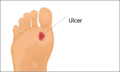 Sedentary behavior increases risk of foot ulcer in Diabetic peripheral neuropathy: Study