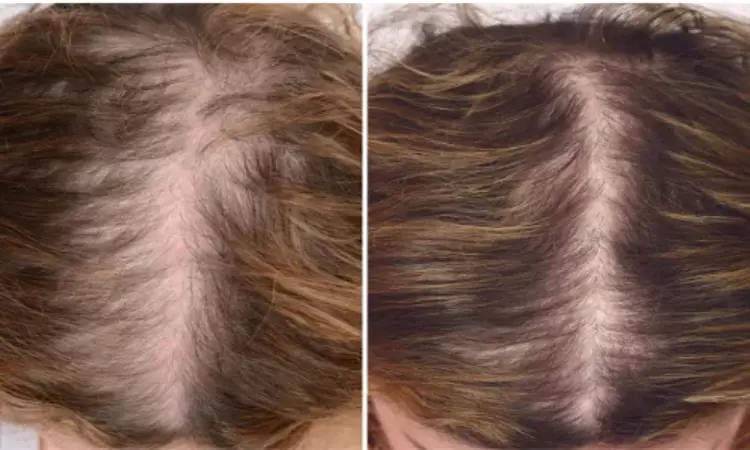 Female Androgenetic Alopecia effectively treated by PRP, finds study