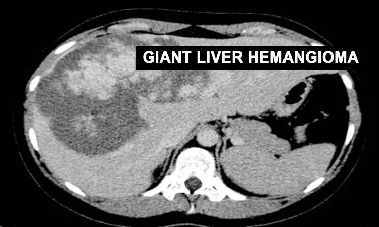 Early surgical resection- a benefit for Giant Liver Hemangiomas: Case report