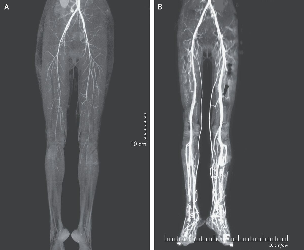 severe-burning-pain-in-legs-after-taking-migraine-medicine-nejm-case