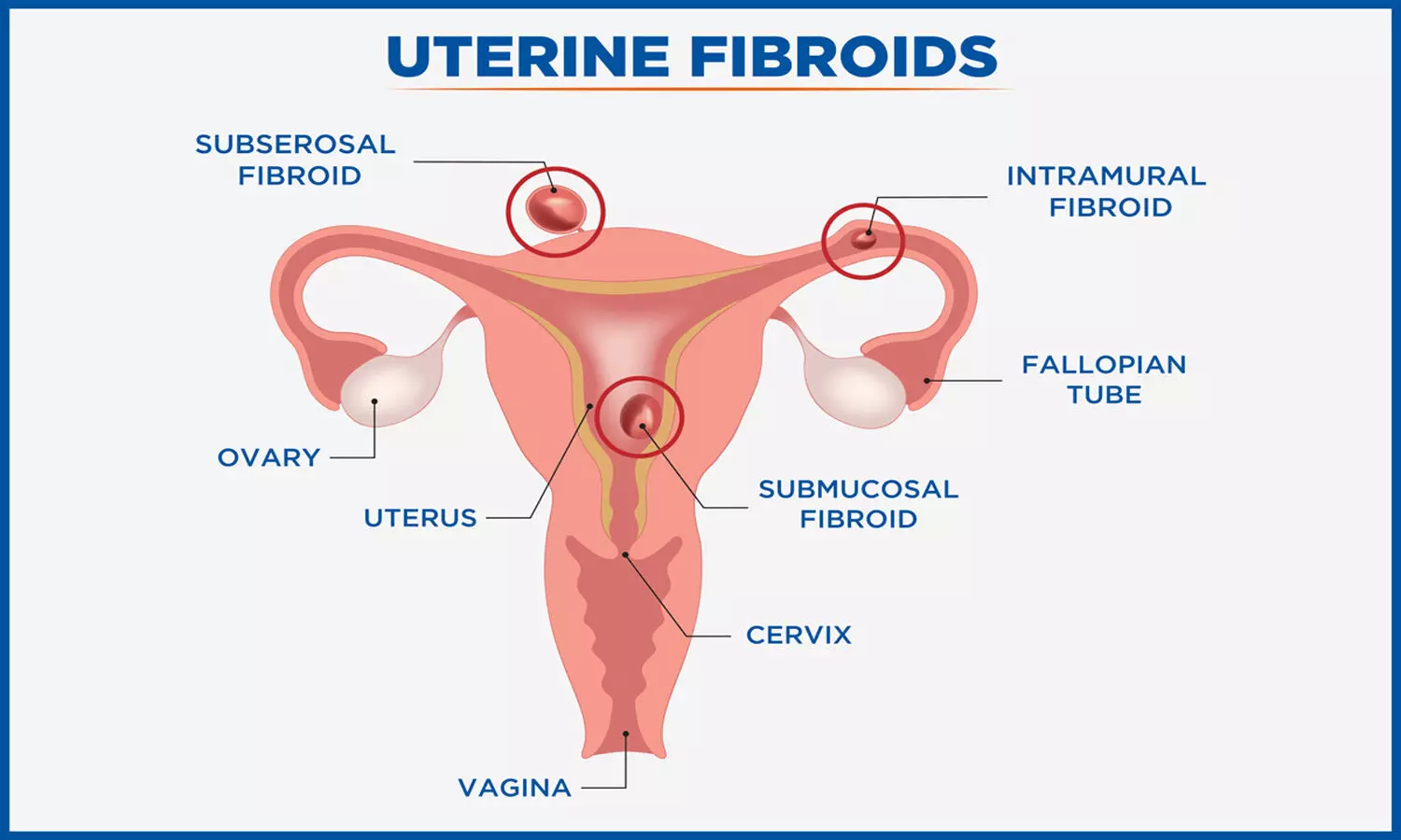 Myomectomy bests uterine artery embolization for treating uterine Fibroids: NEJM study