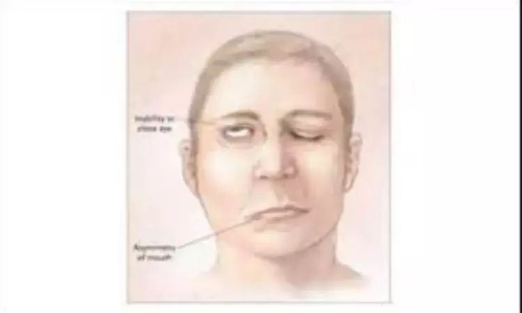 Occult facial nerve palsy: Case of masquerading malignancy reported