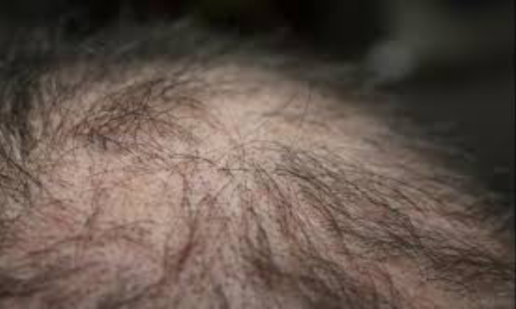 Drug reverses hair loss caused by radiation for brain, head, neck cancers