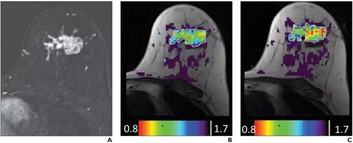 Effect of gadolinium-based contrast agent on breast diffusion-tensor imaging