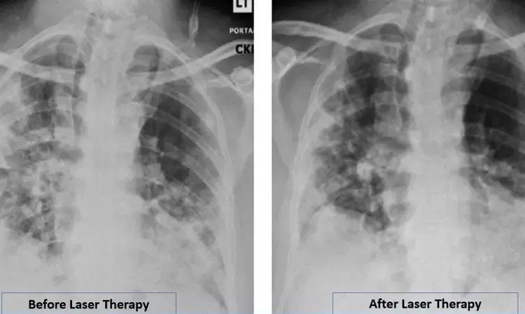COVID-19 Pneumonia Patient significantly Improves with Laser: Case report