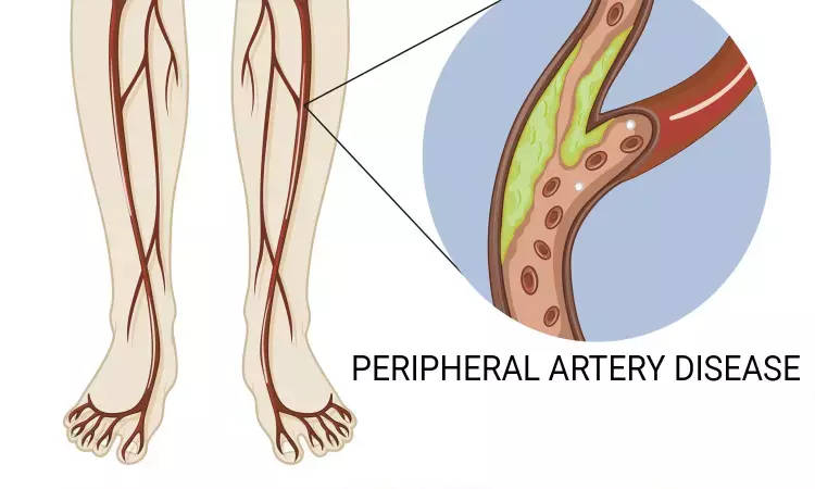Low BP during hemodialysis indicative of peripheral vascular disease: Study