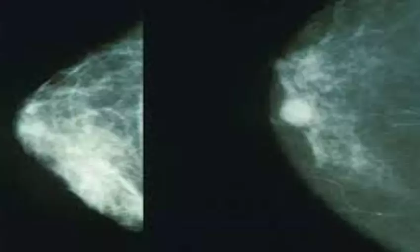 Elastography useful for breast cancer screening in microcalcification cases: Study