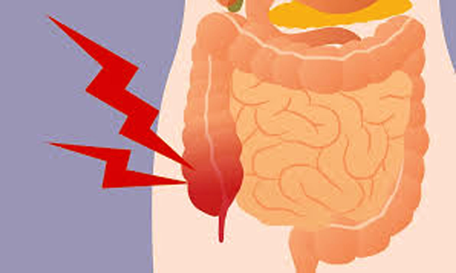 endoscopic-retrograde-appendicitis-therapy-changing-outlook-for