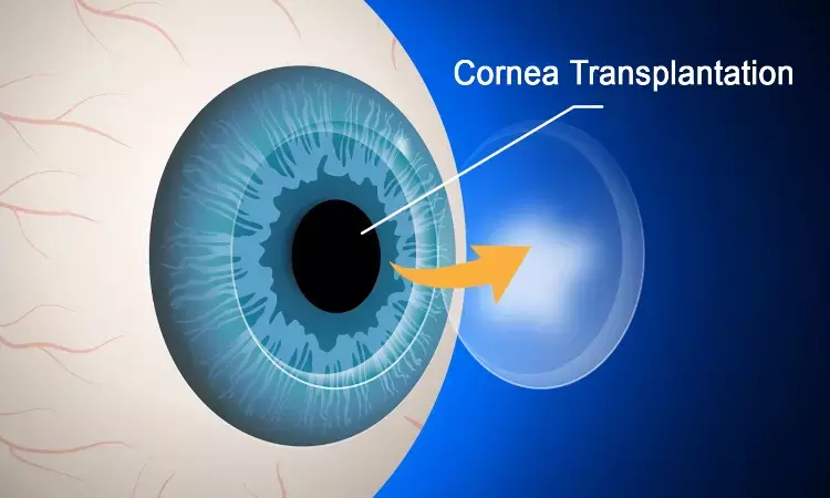 Impact of COVID-19 Pandemic   on Keratoplasty and Corneal Eye Banking: Cornea Journal