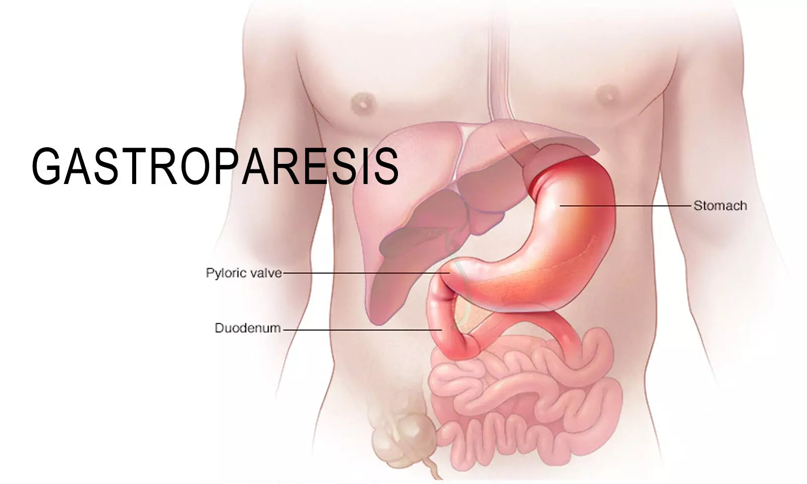 Severe and Refractory gastroparesis can be treated with endoscopic pyloromyotomy: BMJ