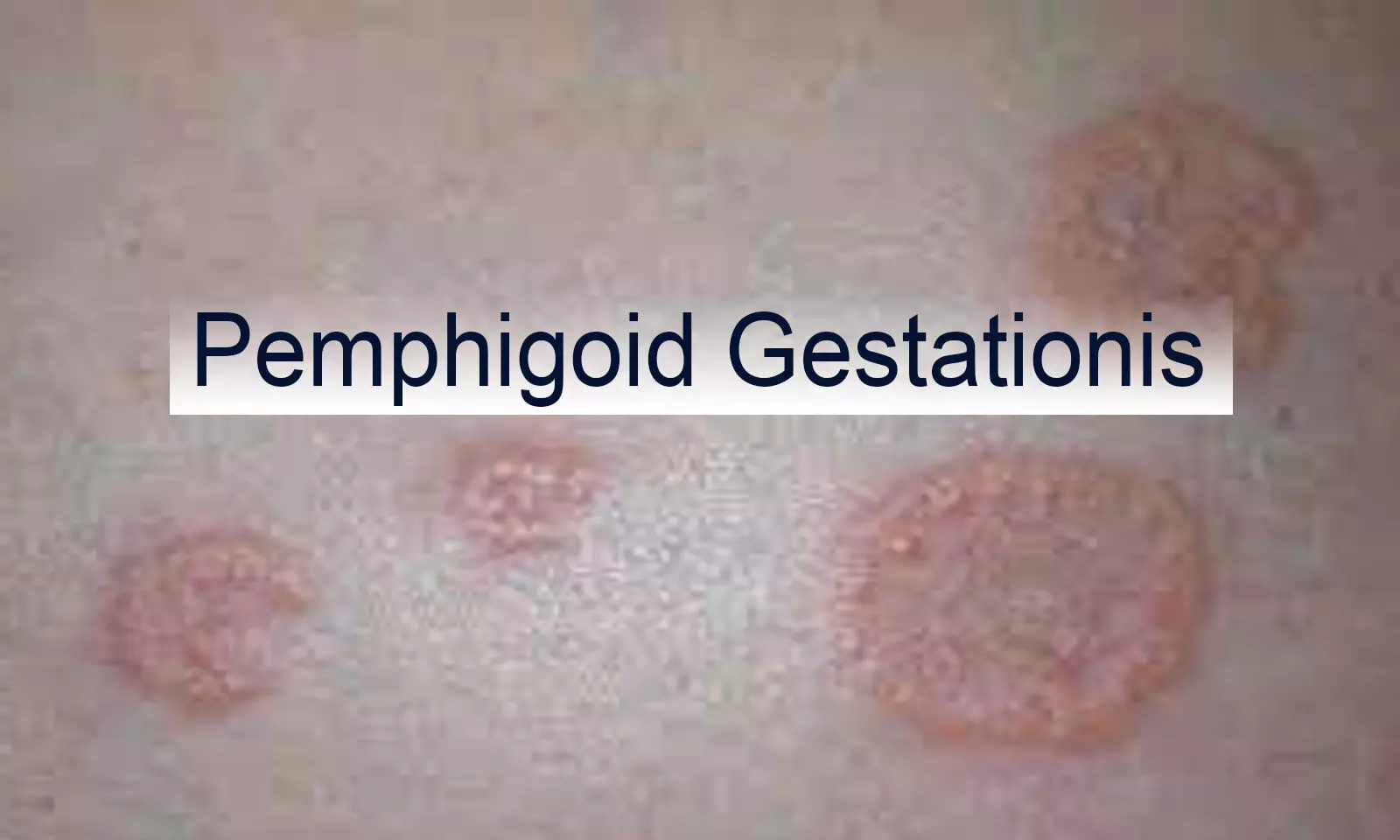 Case of Pemphigoid Gestationis  reported in NEJM