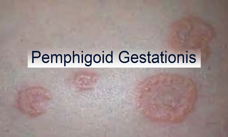 Case of Pemphigoid Gestationis  reported in NEJM