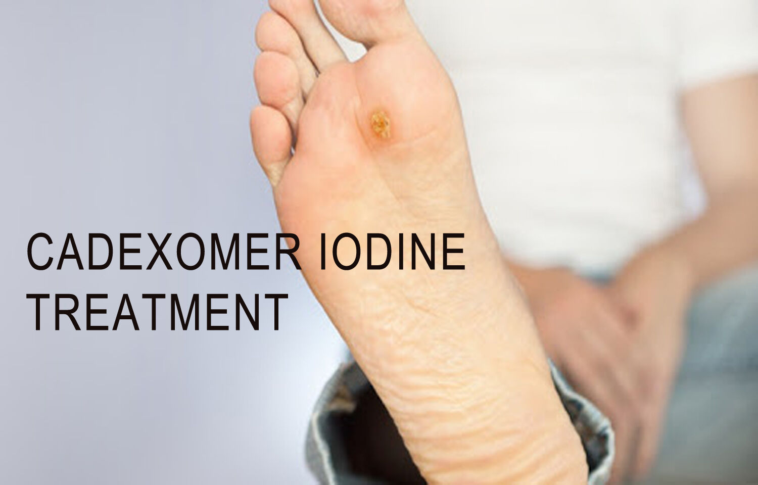 Cadexomer Iodine Treatment of Diabetic Foot Ulcers