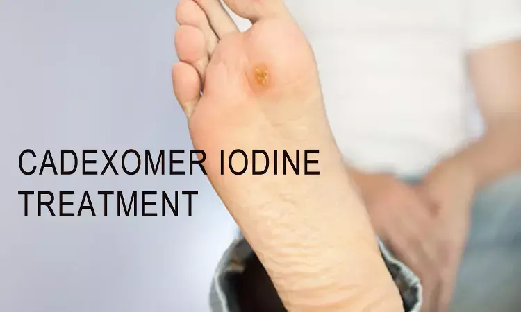 Cadexomer Iodine Treatment of Diabetic Foot Ulcers