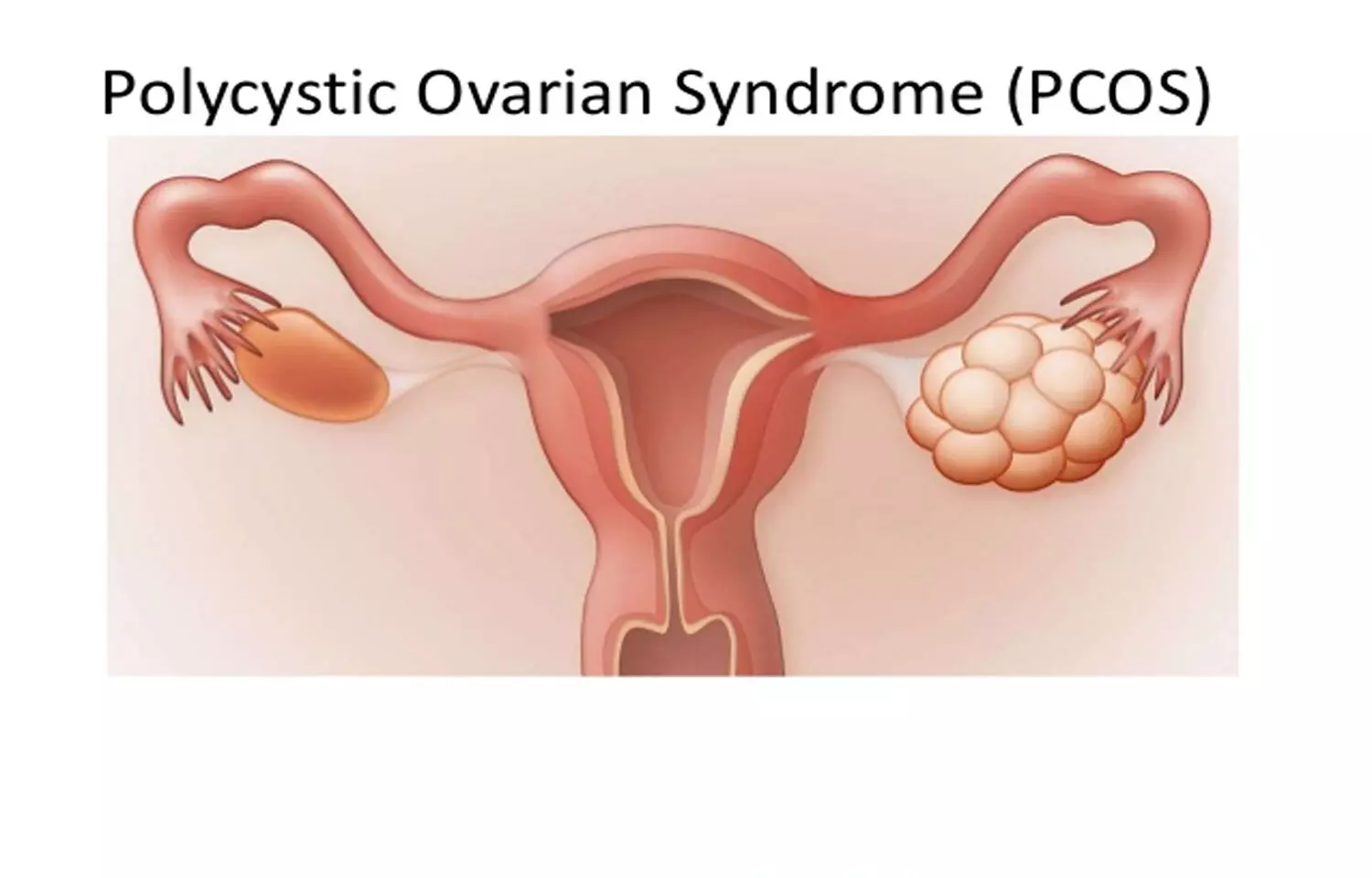 PCOS tied to increased risk of neuropsychiatric disorders in offspring, finds study