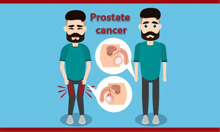 Prostate Cancer may be diagnosed using a urine test with artificial intelligence