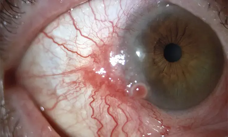 Case of Conjunctival Squamous-Cell Carcinoma reported in NEJM