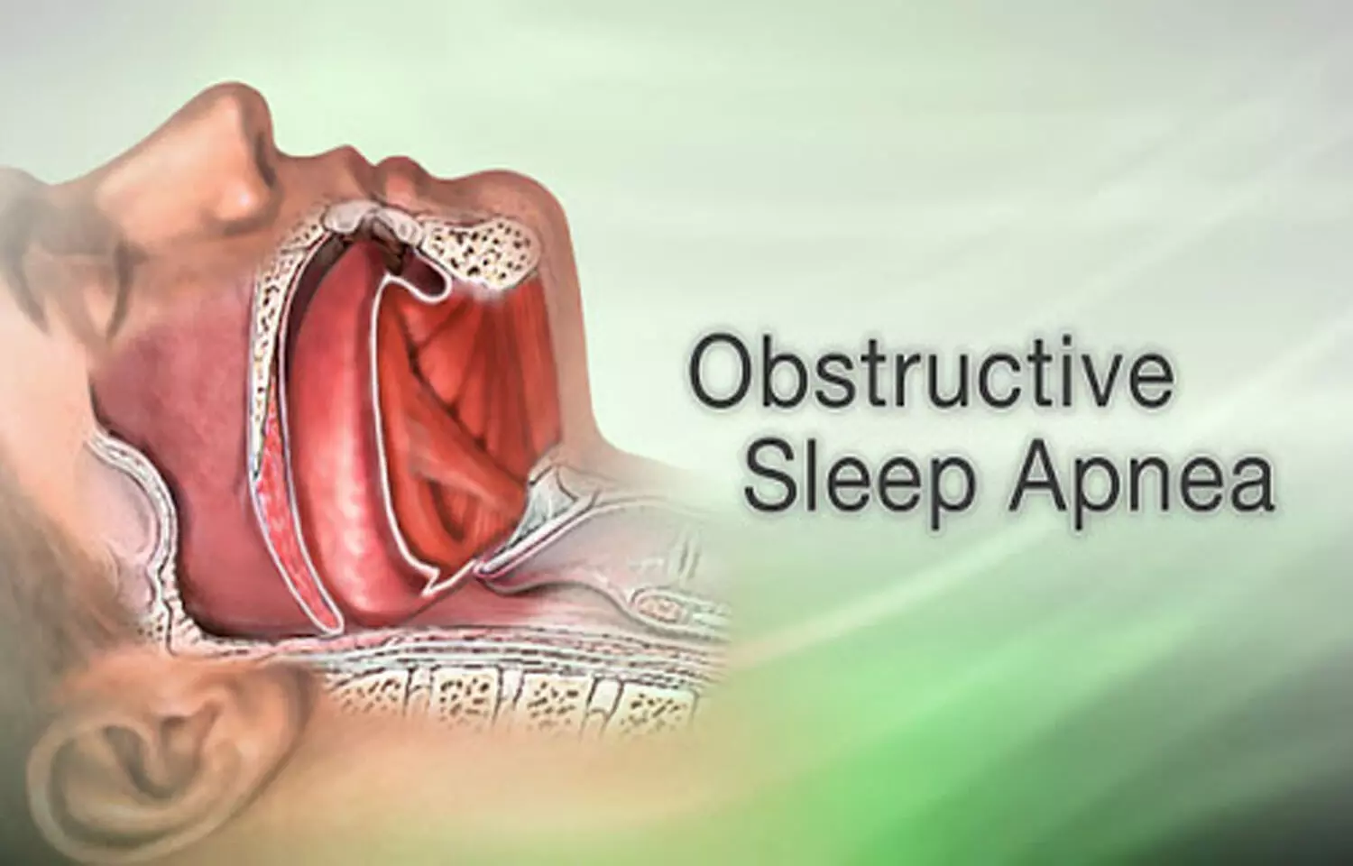 Sleep apnea in kids tied to high blood pressure and adverse heart health: Study