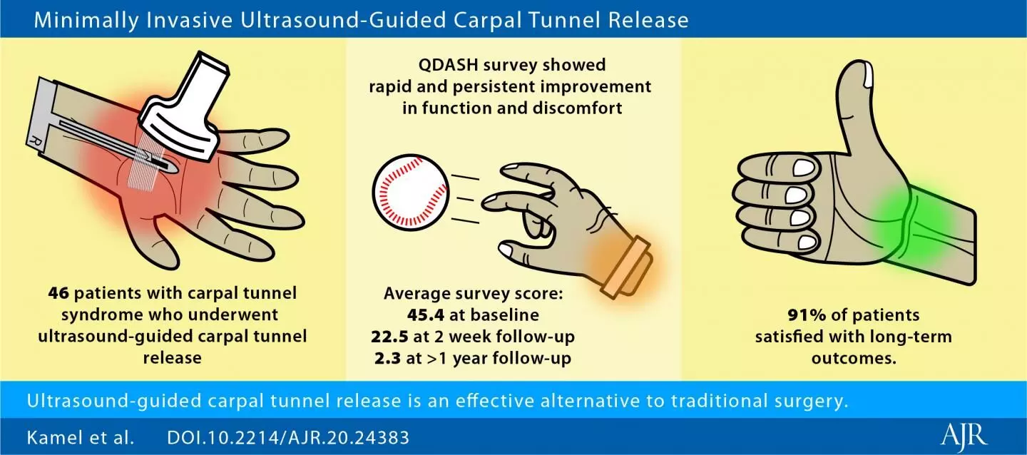 Ultrasound-guided carpal tunnel release less invasive, effective treatment option