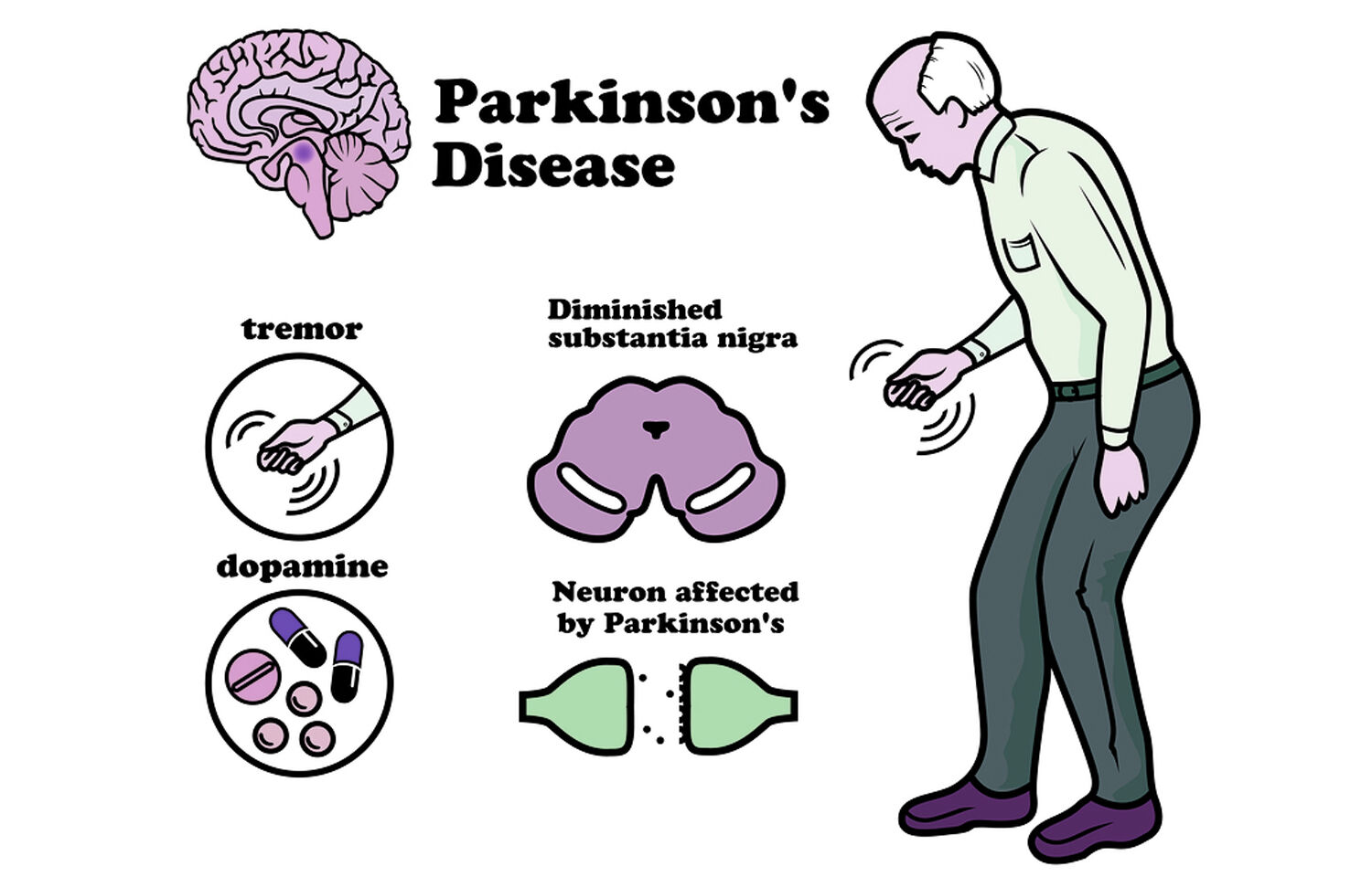 cognitive-decline-greater-in-male-parkinson-s-disease-patients-finds-study