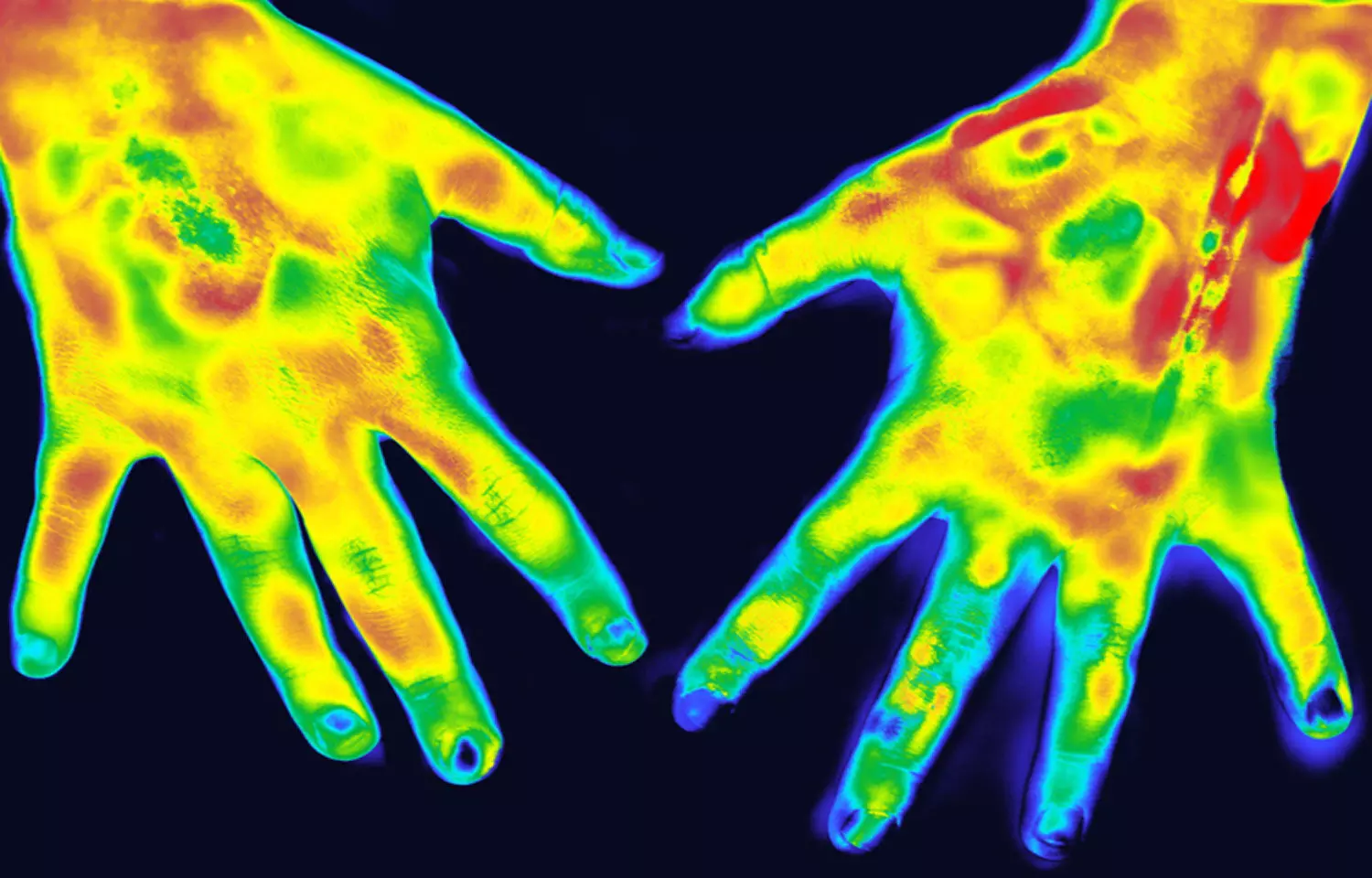 Thermography effective imaging method for rheumatoid arthritis: Study
