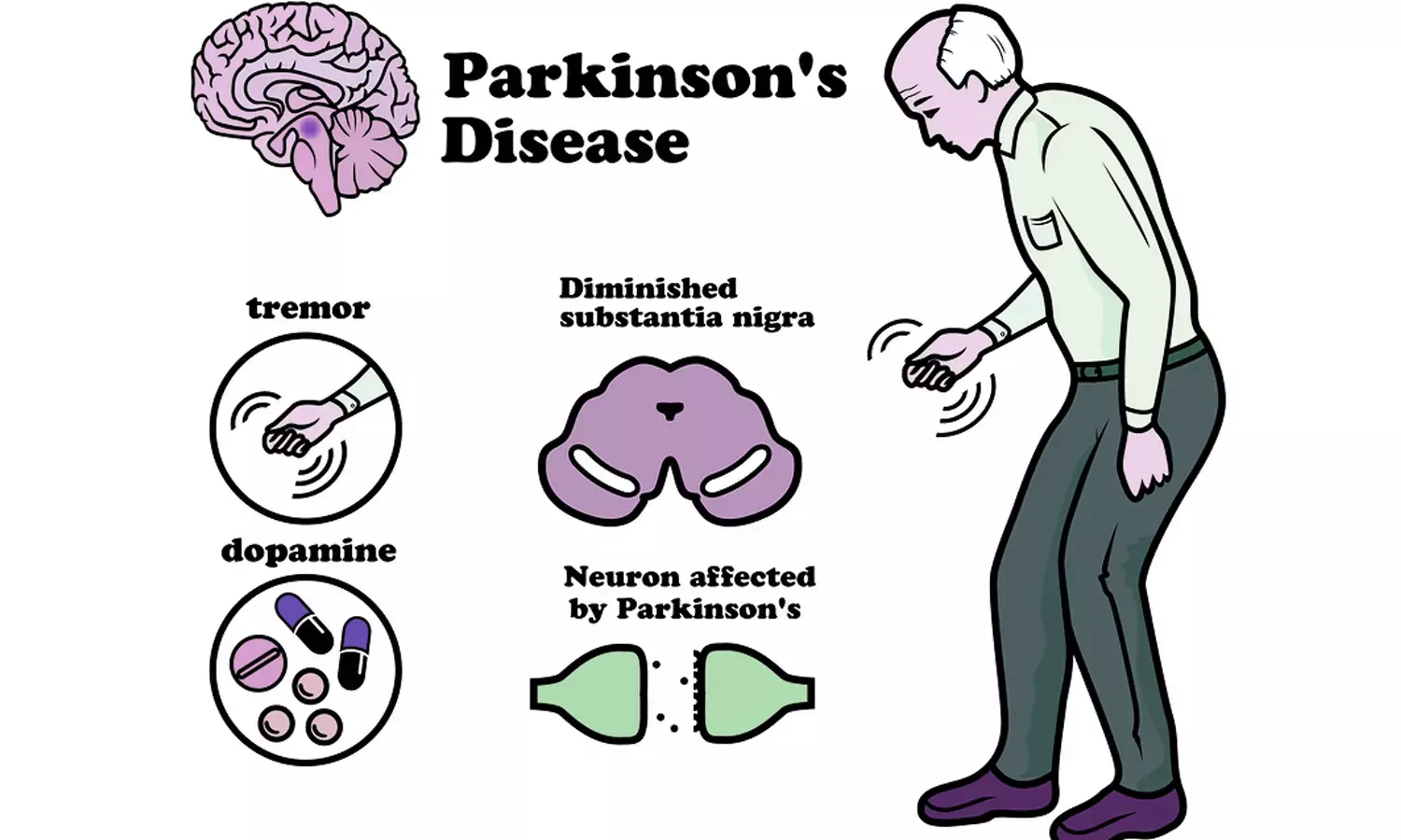 Признаки паркинсона у мужчин после 60. Синдром Паркинсона неврология. Клинические признаки болезни Паркинсона. Синдромы при болезни Паркинсона неврологические. Дофамин при болезни Паркинсона.