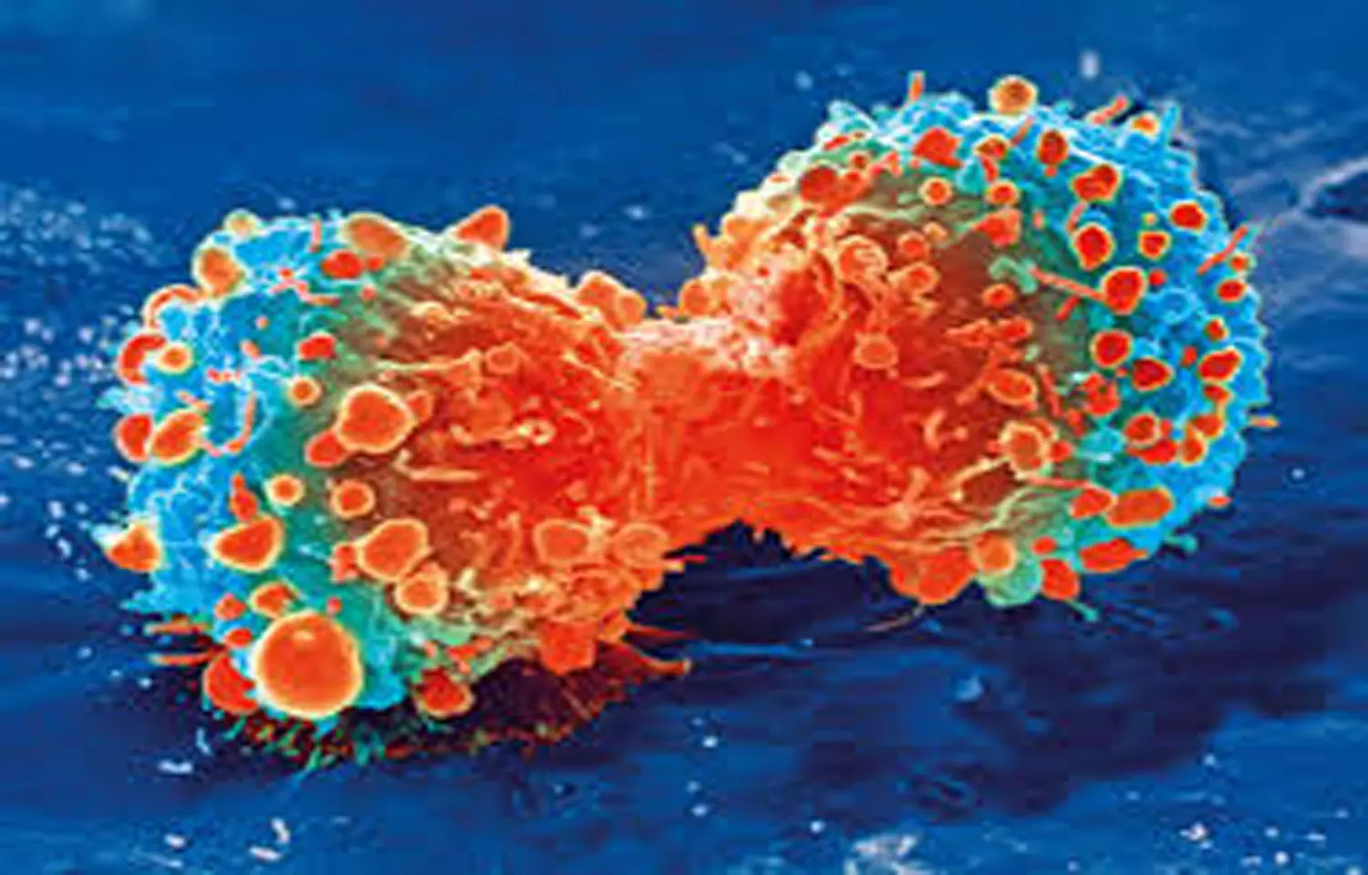 Targeted drug shows activity against brain metastases in kidney cancer
