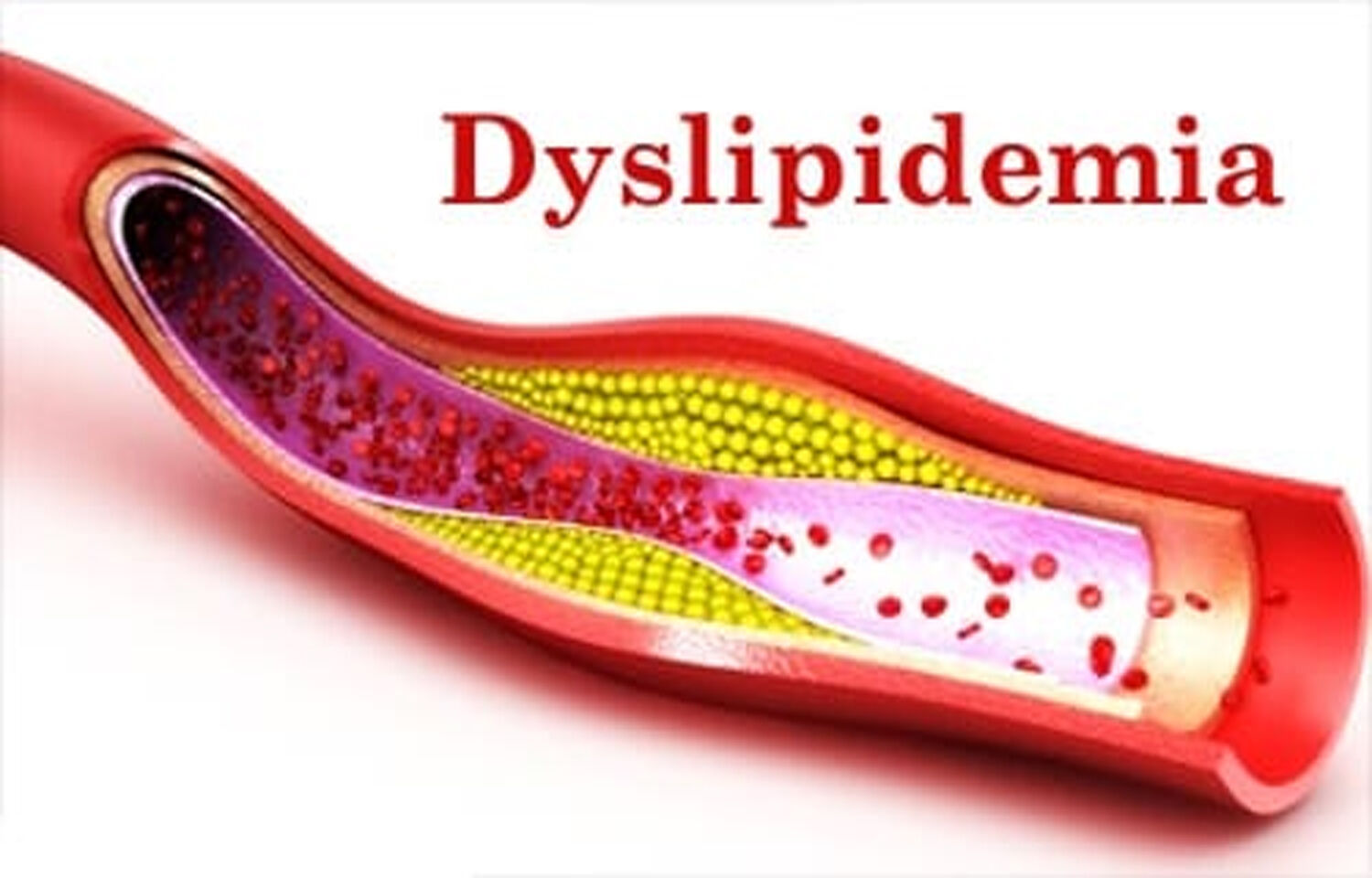 Vadod Dyslipidemia Guidelines Recommend Against Frequent Ldl Testing 0926