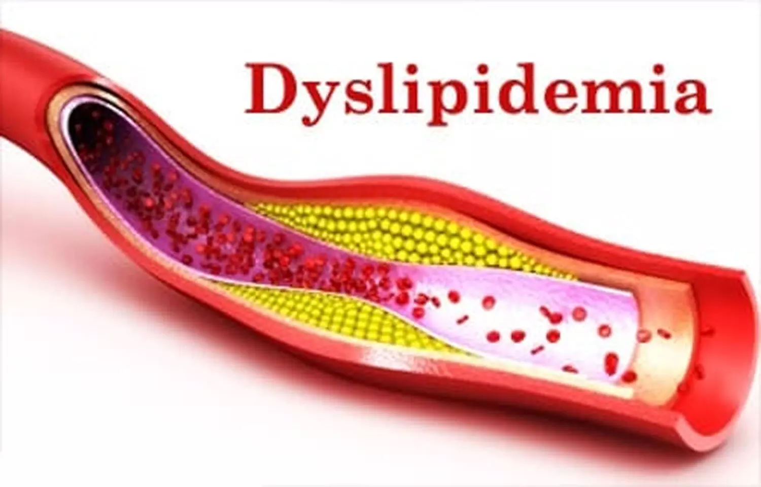 Vadod Dyslipidemia Guidelines Recommend Against Frequent Ldl Testing 2901