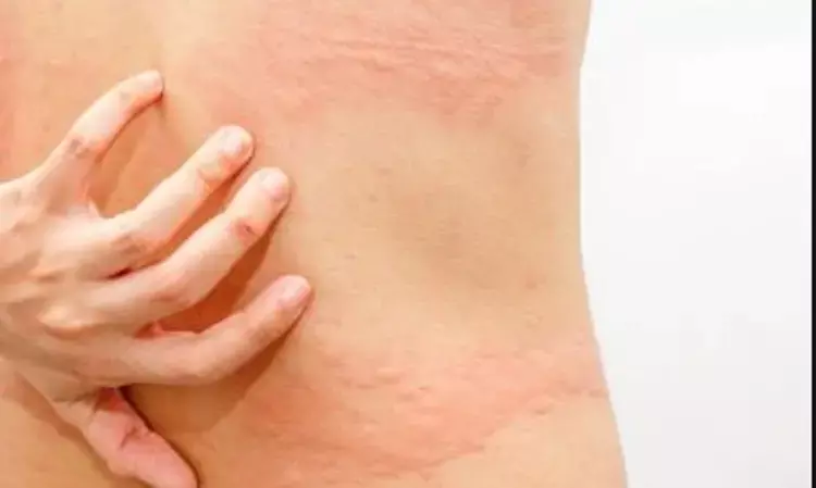 Olopatadine bests rupatadine for treating chronic idiopathic urticaria, finds study