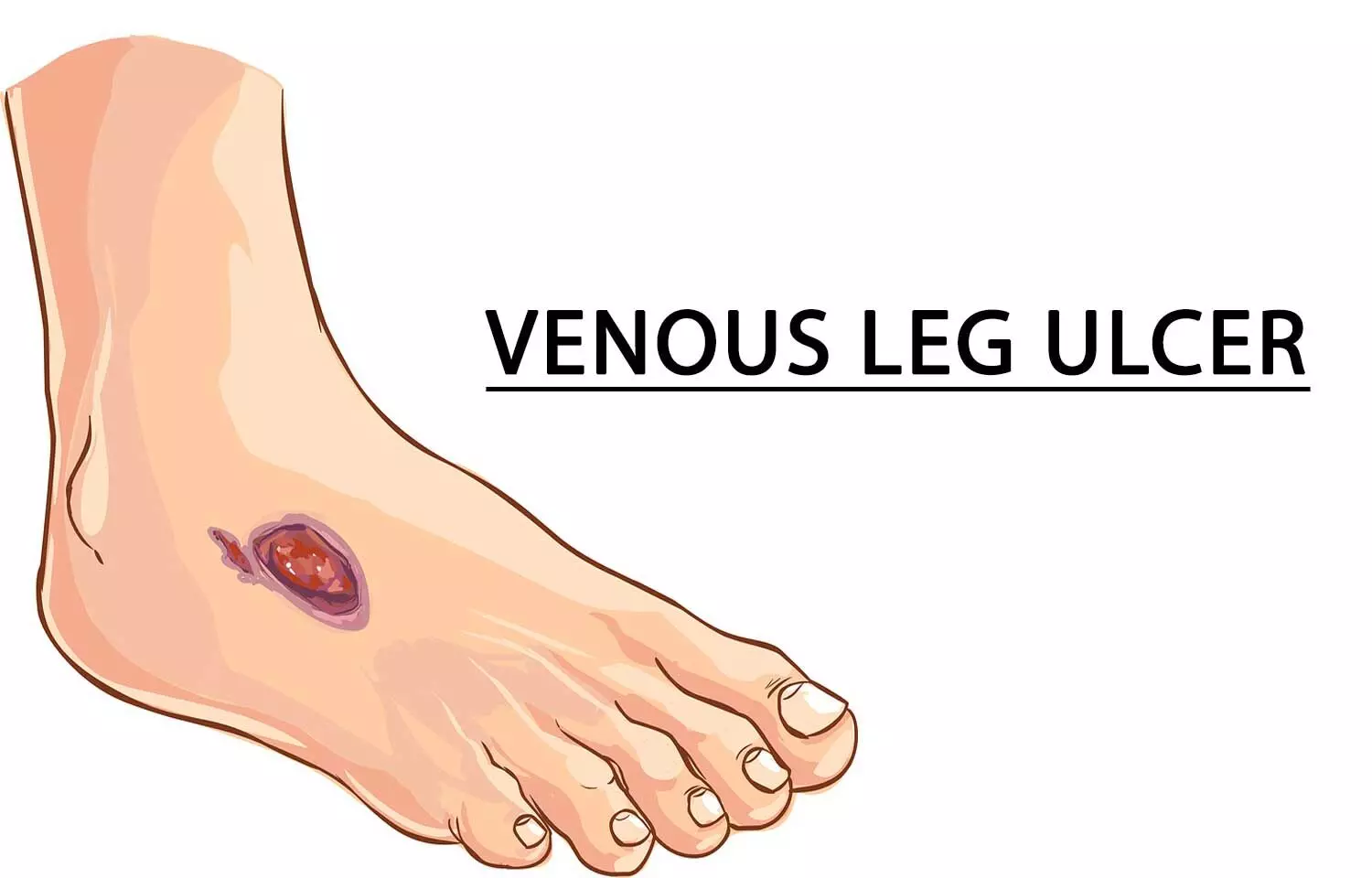 Early surgical interventions linked to faster healing of venous leg ulcers: Study