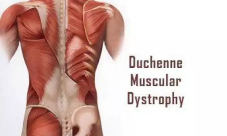 Vamorolone found effective in Duchenne muscular dystrophy in Duke trial