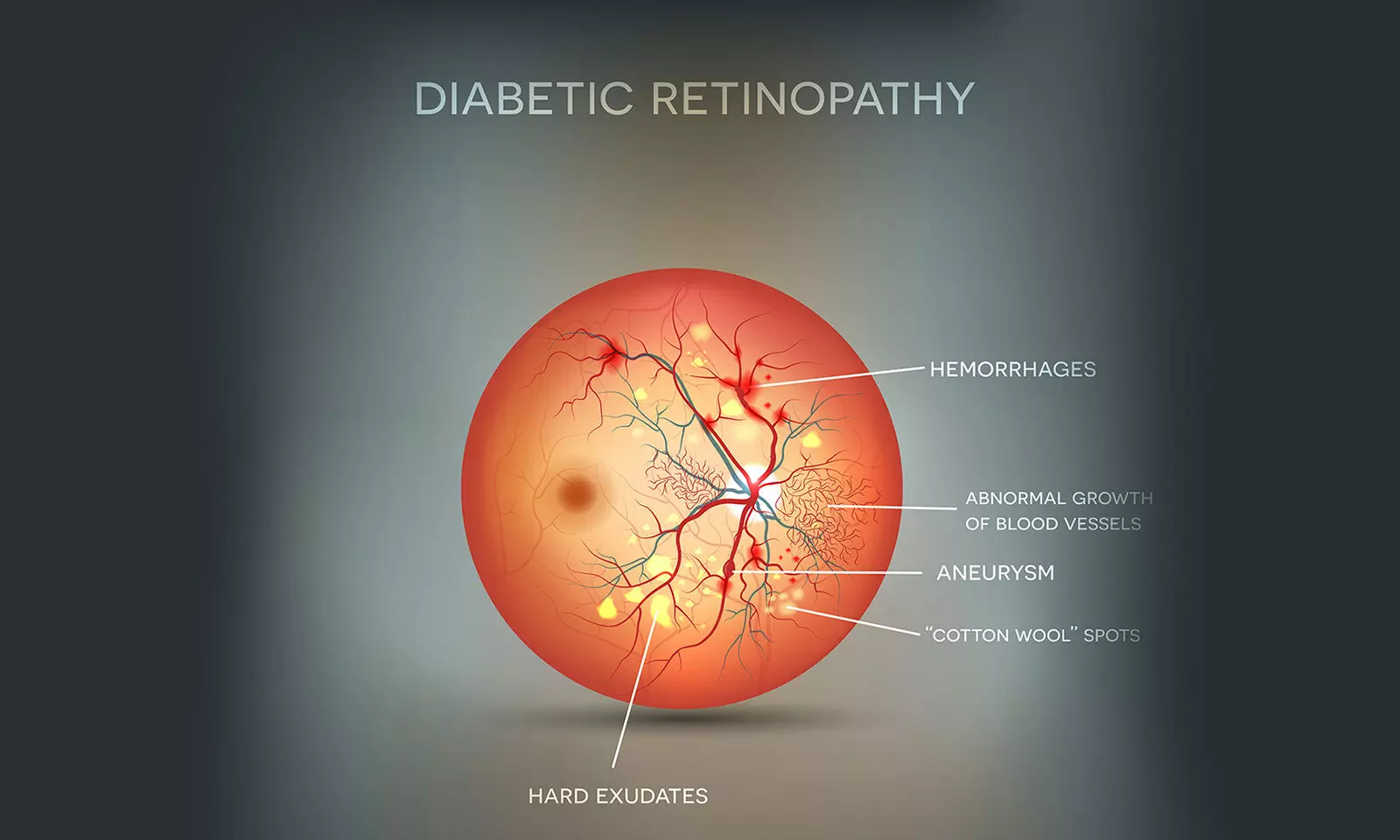 Global Diabetic Retinopathy Industry