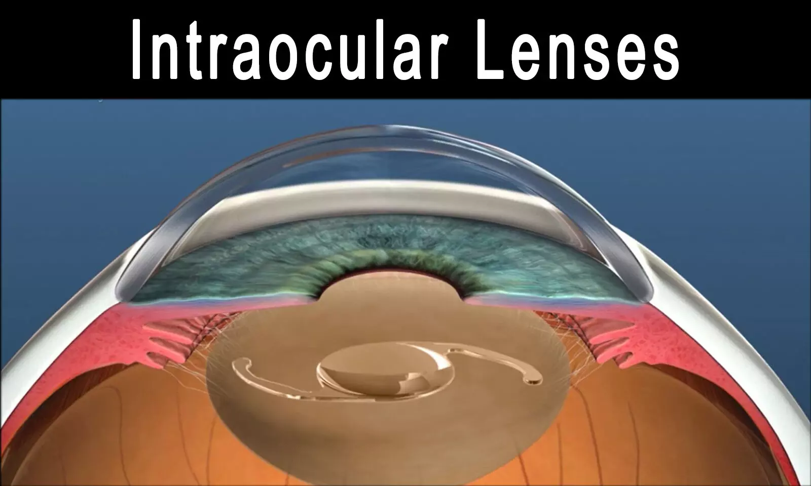 Implantation techniques for reconstruction of anterior segment after ocular trauma