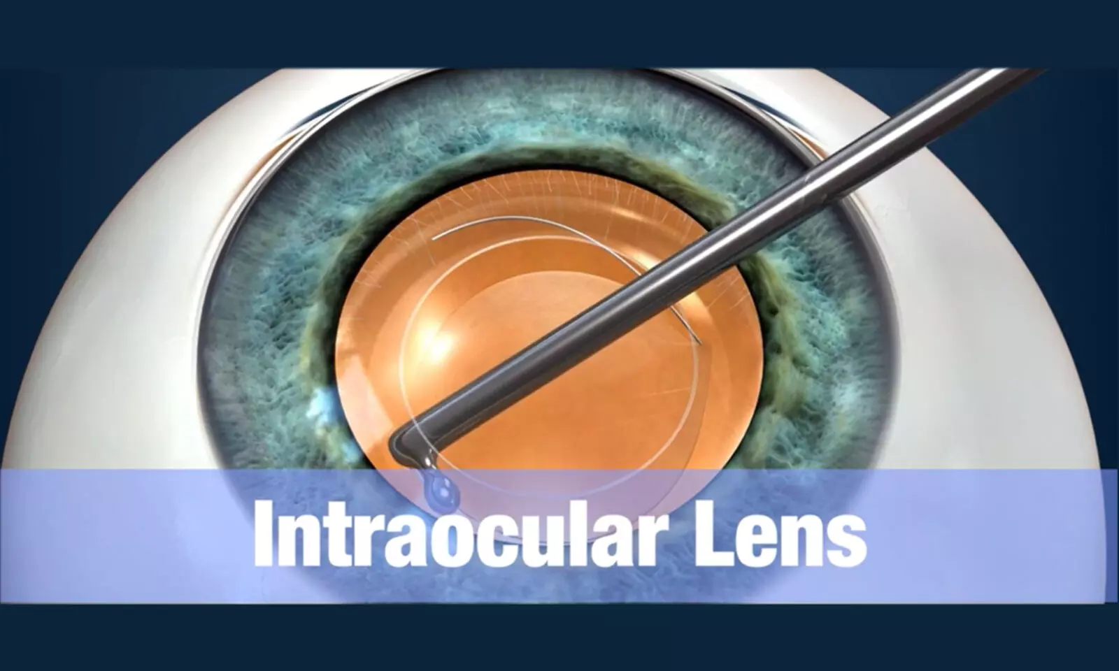 Use of Artificial tears drops reduces refractive errors after cataract surgery