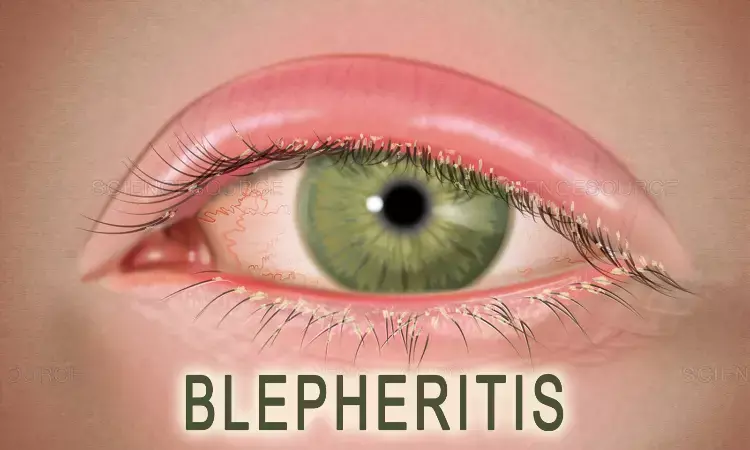 Lotilaner Ophthalmic Solution Promising Treatment for Demodex Blepharitis: Study