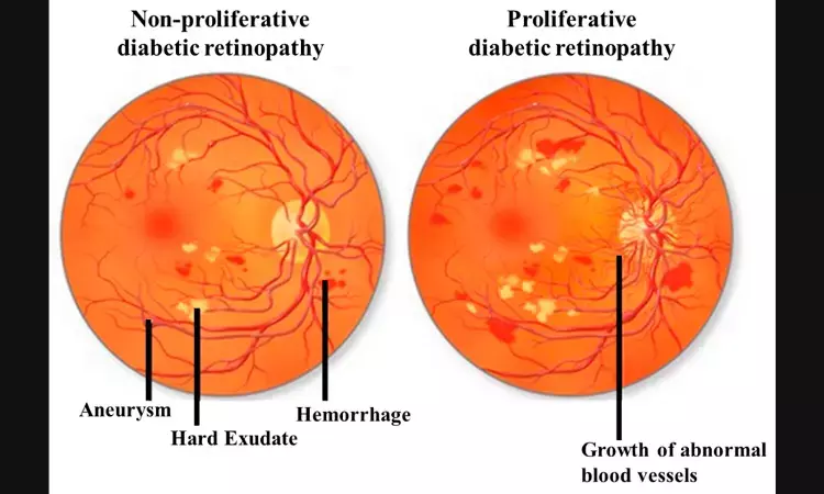 Children with T2D have a higher risk of developing retinopathy than those with T1D: JAMA