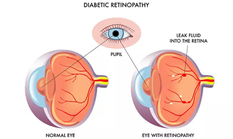 Consumption of diet with higher Inflammatory Index Linked to Increased Risk of Diabetic Retinopathy
