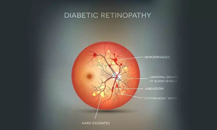 High levels of serum progesterone associated with Diabetic retinopathy; finds study