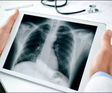 Diagnostic accuracy of serial Chest X-ray as good as chest CT in COVID-19, finds study