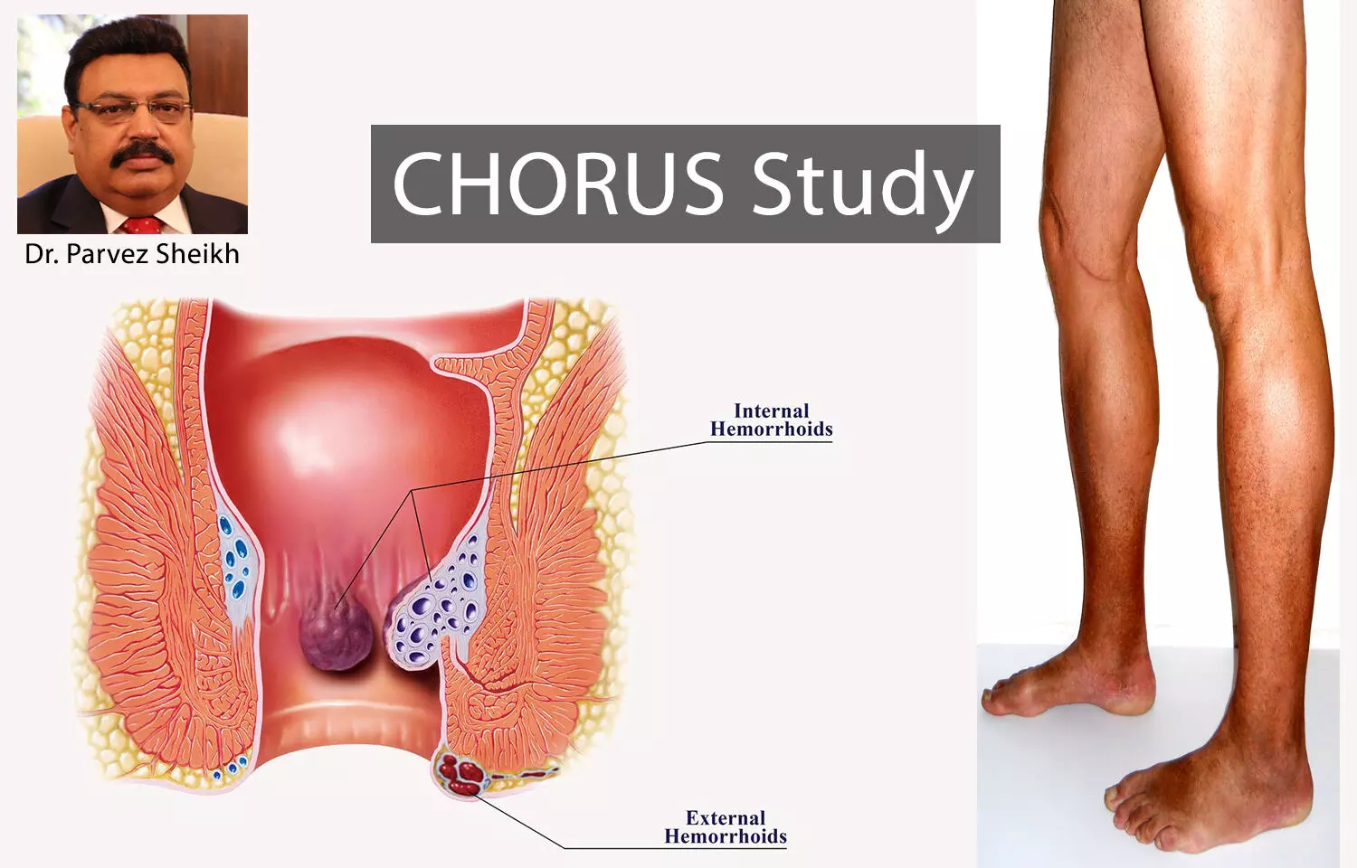 Strong Association between hemorrhoidal disease and Chronic Venous Disease: Indian Sub-analysis of CHORUS Study