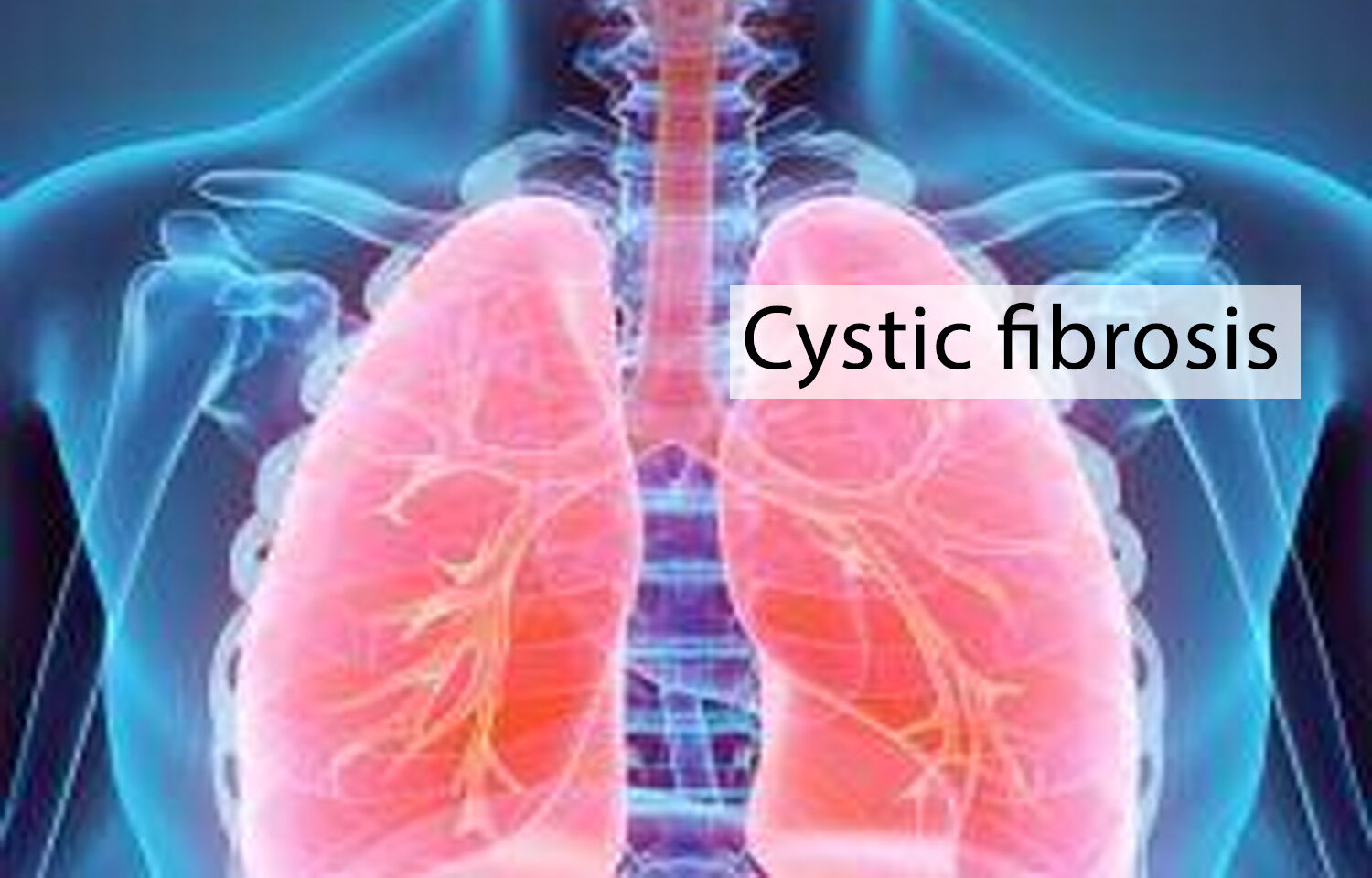 Cystic Fibrosis Pictures