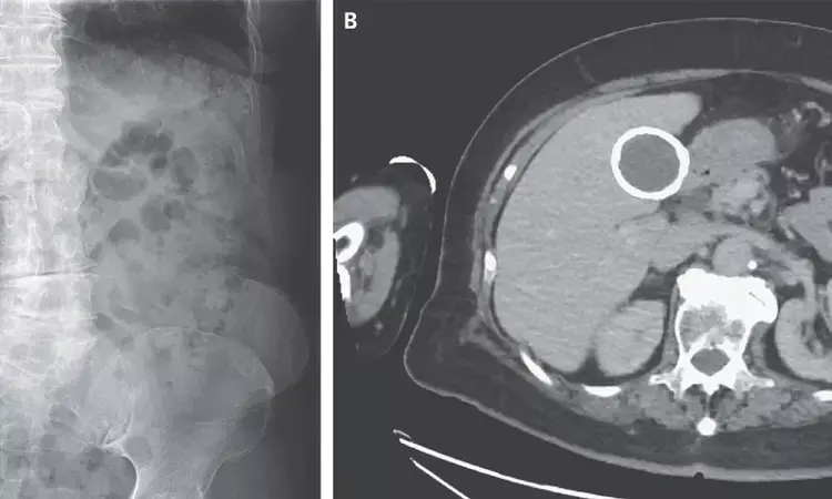 Rare Case of calcified gallbladder reported in NEJM