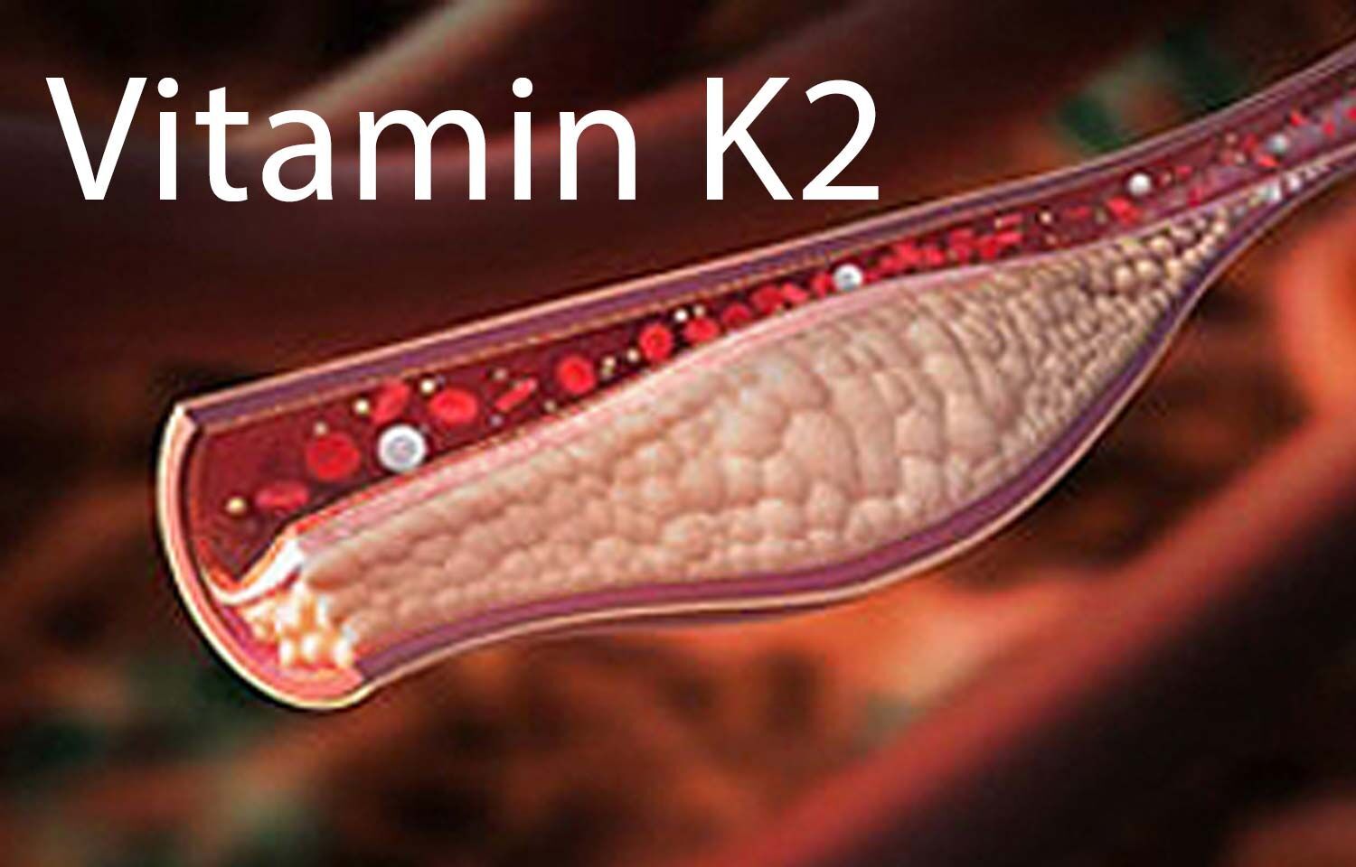 Role of Vitamin K2 in managing vascular calcification Review