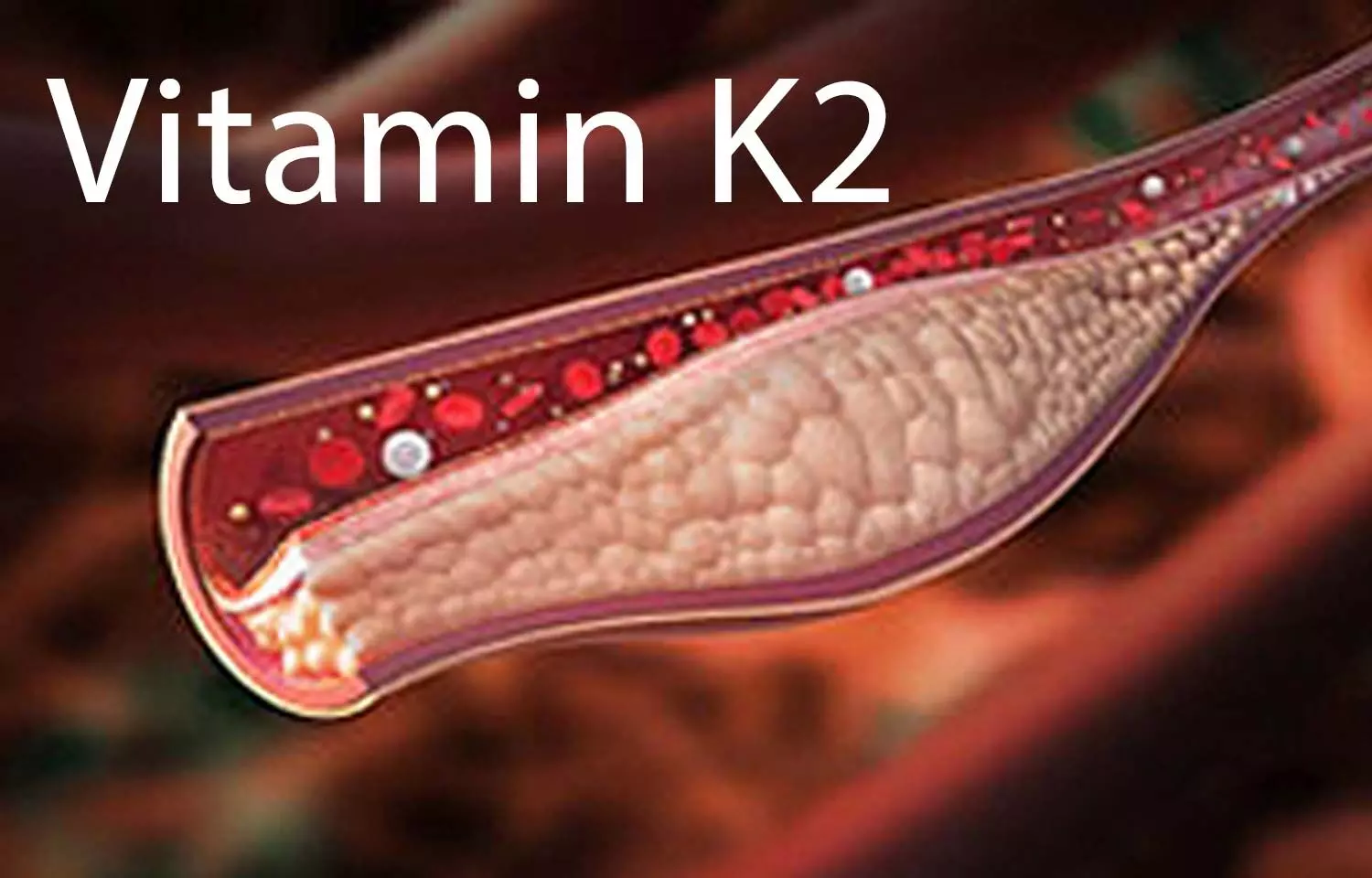 Role of Vitamin K2 in managing vascular calcification: Review