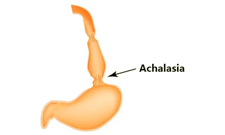 Opioid-induced achalasia successfully managed with naloxegol: Case report