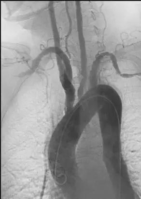 Rare case of Takayasu Arteritis camouflaged with Resistant Hypertension and Tuberculosis