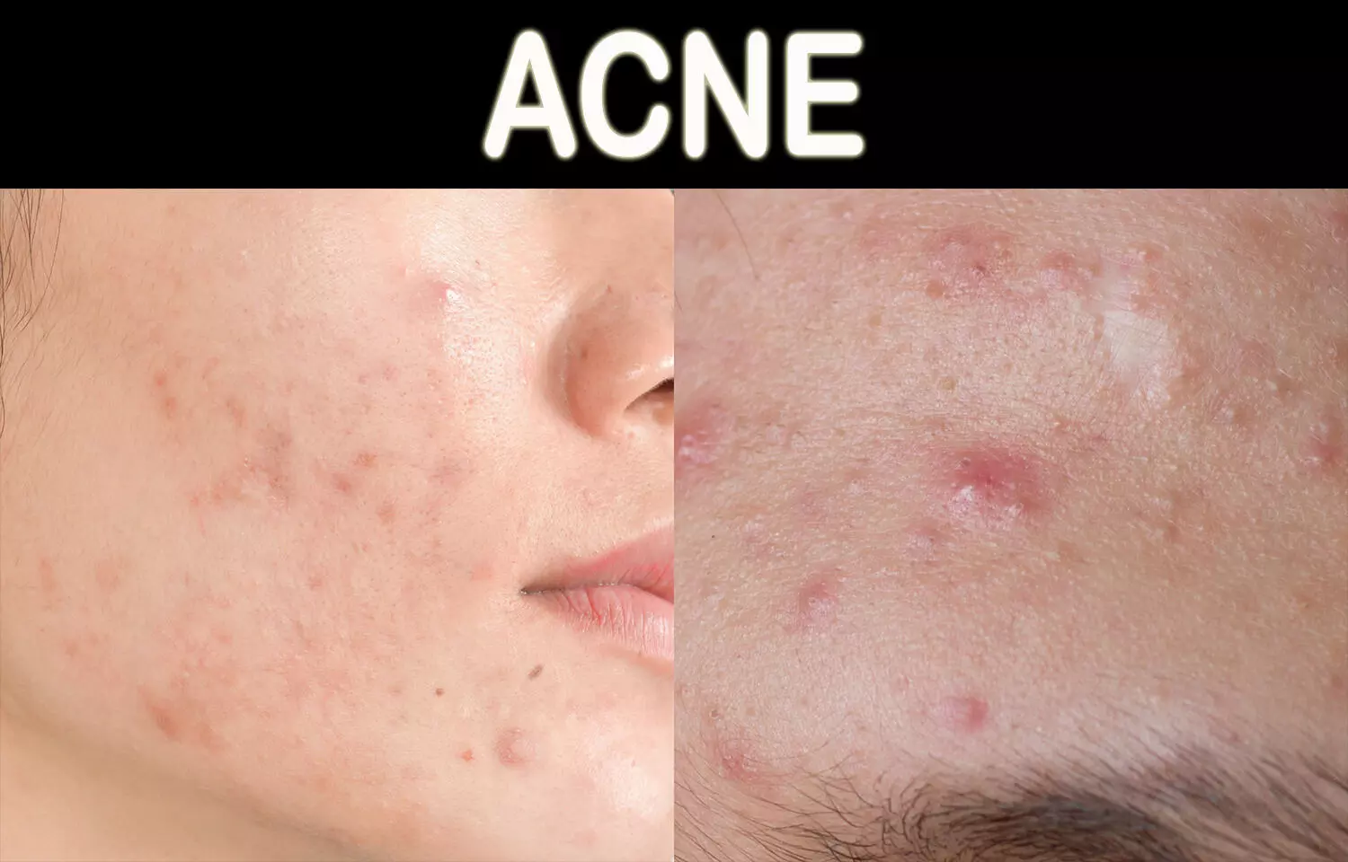 Not all acne bad: scientists reveal strains of C. acnes that promote skin health