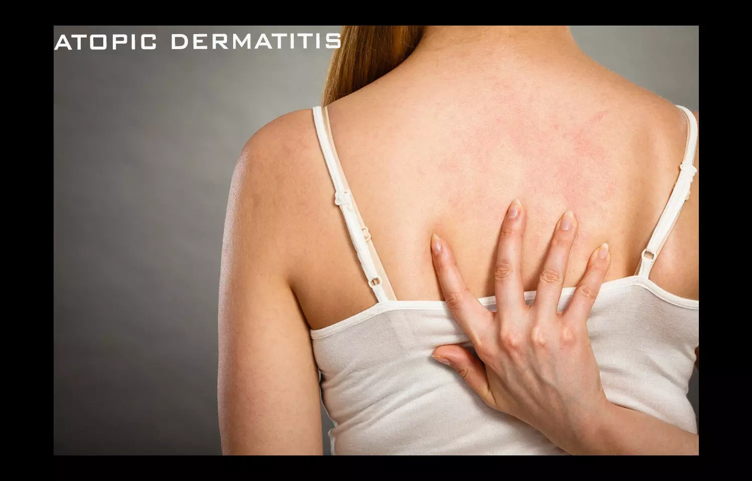 Whats new in atopic dermatitis: JEADV updated guidelines