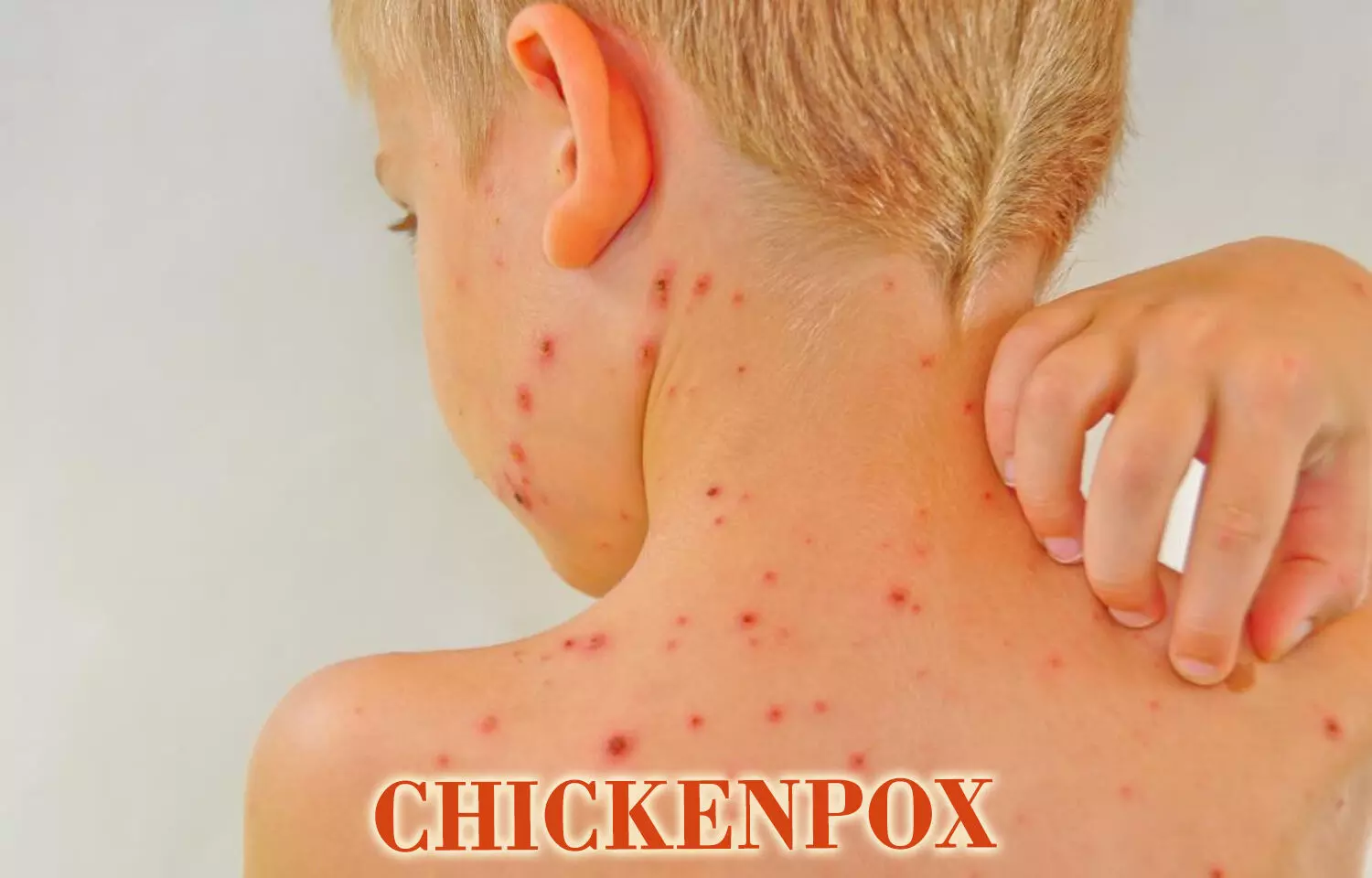 Vaccination and Antivirals Key to Preventing Severe Varicella-Zoster Virus Complications: Study